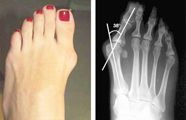 Hallux Valgus